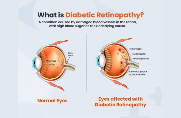 Can Diabetic Retinopathy Be Reversed?